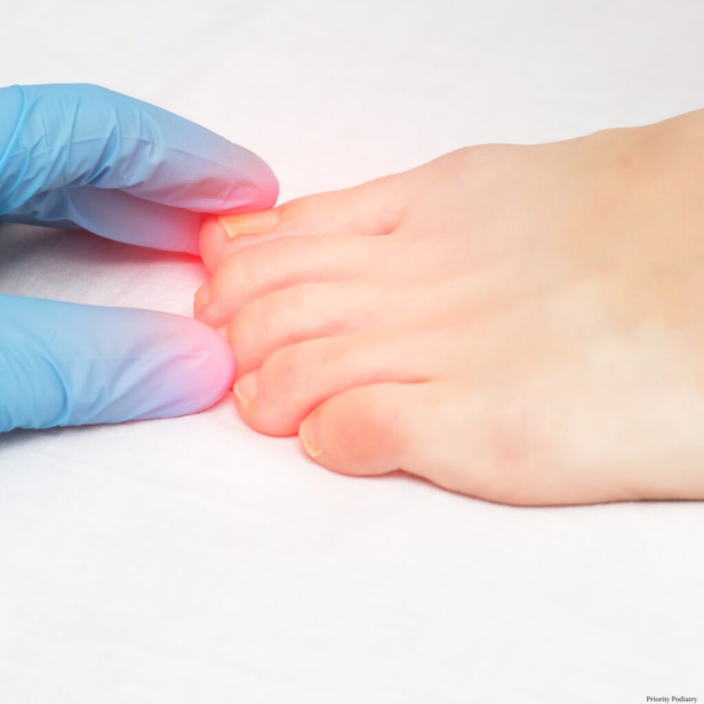 Pain radiating from left foot toes, ingrown toenail