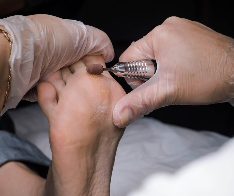 Podiatrist mandrilling corns and callus off the right foot of patient lying down