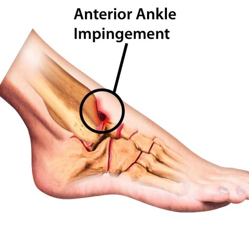 image displaying the location of an anterior ankle impingement