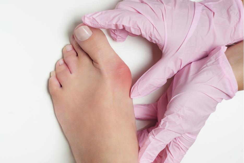 Bunion on the 1st MTPJ with a podiatrist diagnosing with pink gloves, left bunion redness surrounding joint