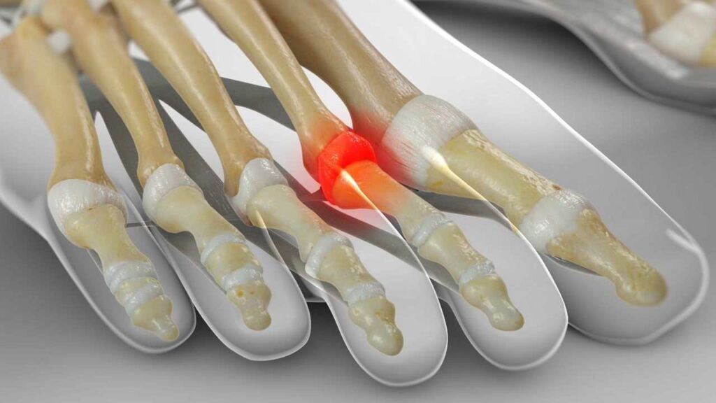 diagram indicating the area of pain that would be in the foot when suffering with capsulitis