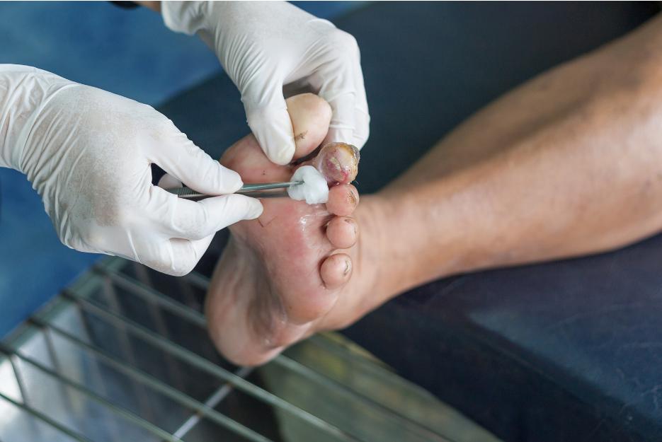 Diabetic Foot wound