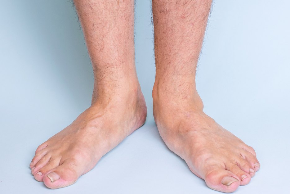 flat feet