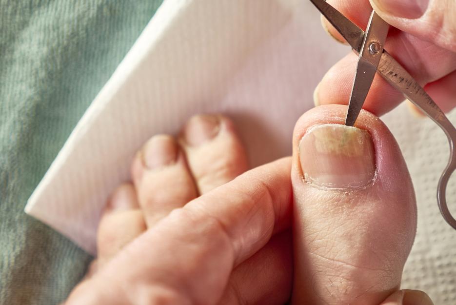fungal toe nail displayed