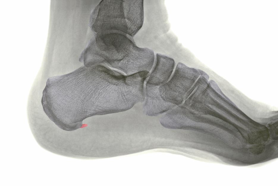 xray image of a heel spur with the heel spur indicated by red in the photo