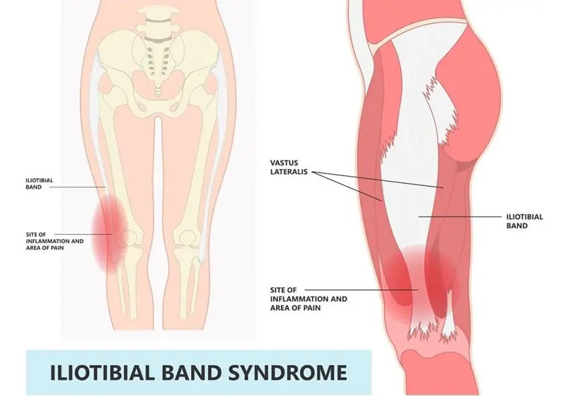 diagram indicating where the pain and inflammation would be with Iliotibial Band Syndrome