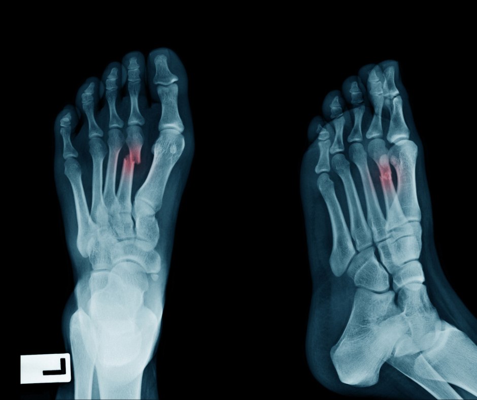 Stress Fracture that had worsened to a complete fracture of the second metatarsal bone, xray
