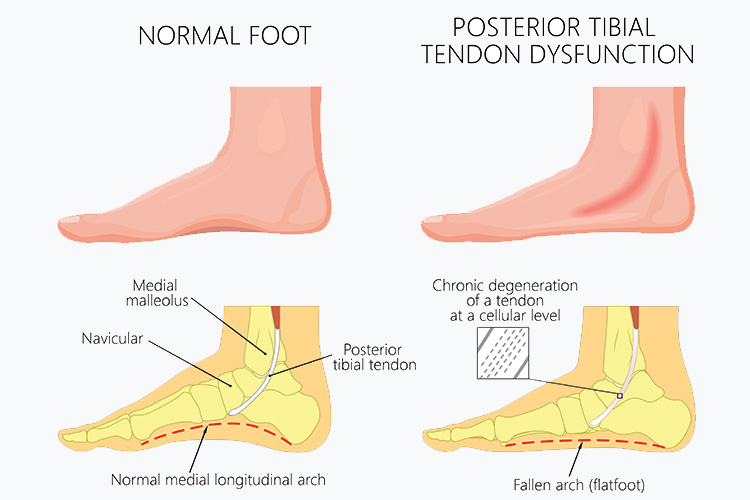 posterior tibial tendon dysfunction comparing to normal