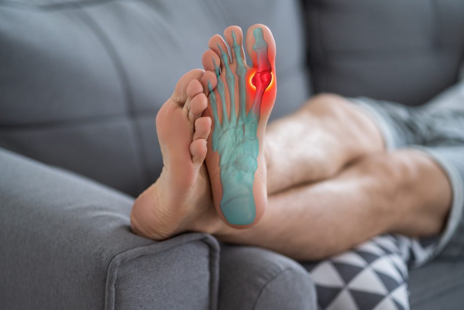 lying down with feet crossed over pain in R 1st metatarsal phalangeal joint, possibly caused by gout indicated by redness surrounding the joint