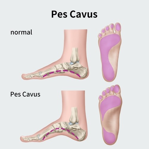 high arched foot comparison to normal