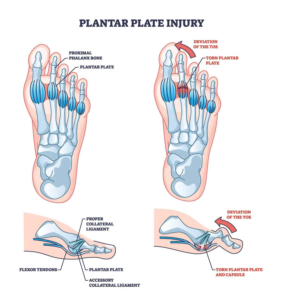 diagram of plantar plate on the Left foot with description of anatomy and indication of plantar plate tear