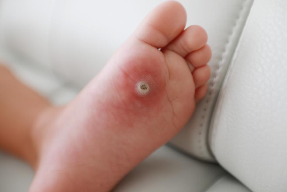 Plantar wart under plantar metatarsal area one left foot, redness surrounding the area