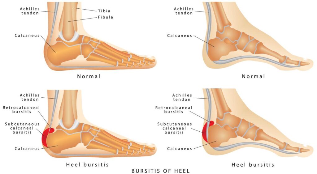 a comparison of normal foot structures vs a foot with heel bursitis and retrocalcaneal bursitis