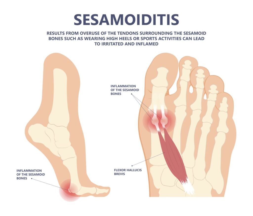 diagram explaining and displaying where the pain from sesamoiditis would be caused, while containing text explaining how it is caused