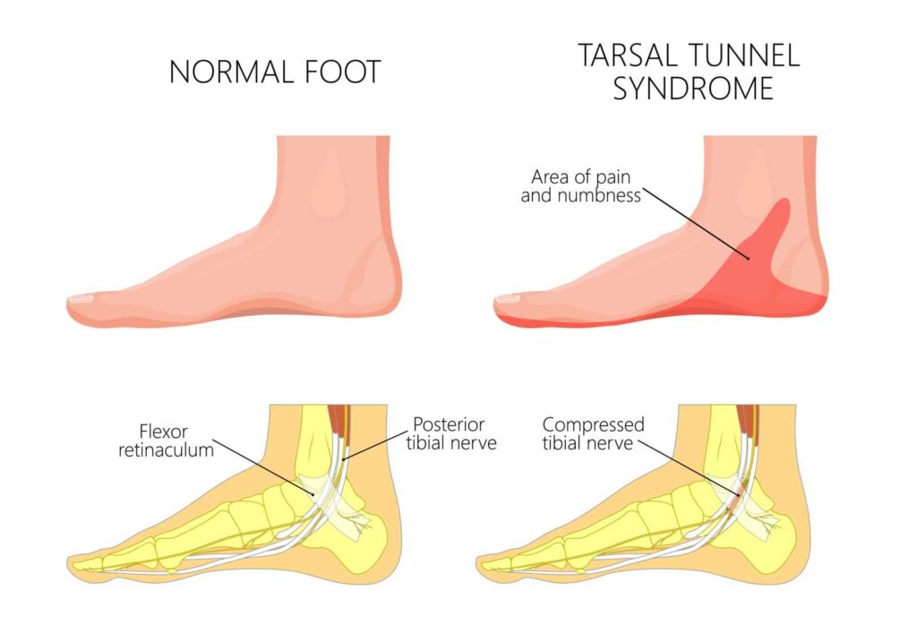 diagram comparing normal foot versus a foot with tarsal tunnel syndrome