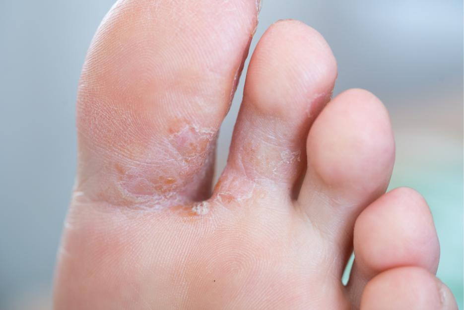Tinea pedis on left foot inter digitally between digit one and two causing irritation and scaling of skin