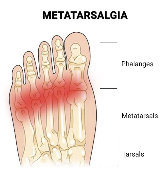 forefoot pain indicated by red colour surrounding the distal metatarsals, metatarsalgia