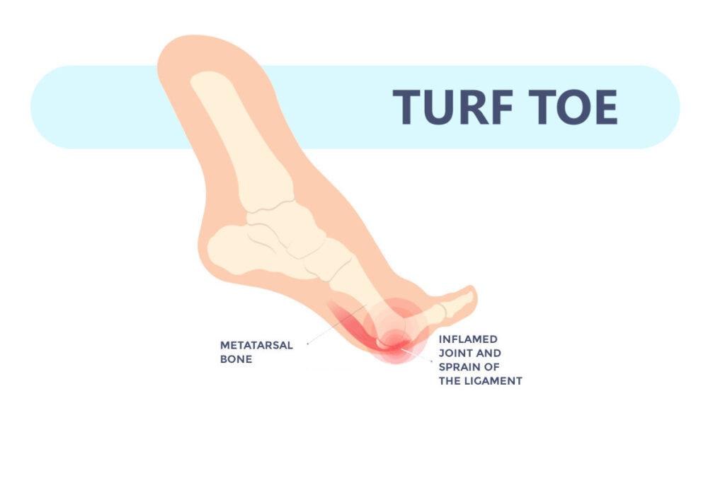 diagram indicating turf toe and what structures would be damaged